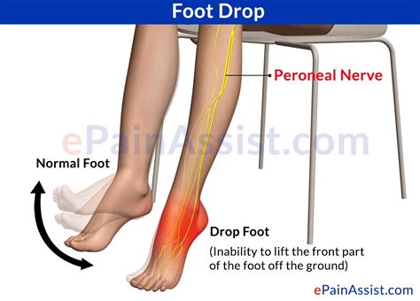 is foot drop serious